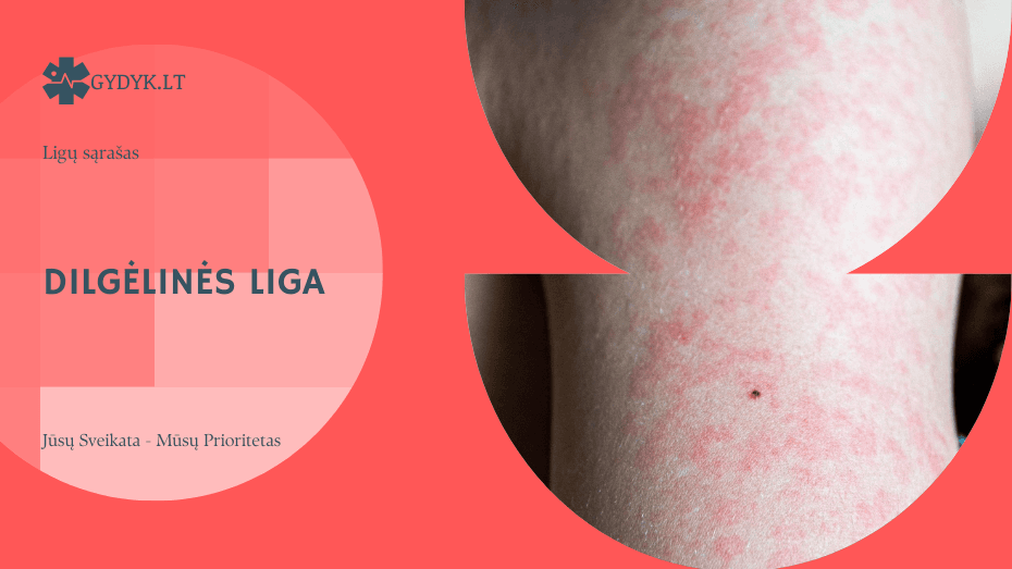 Dilgėlinės liga: priežastys, simptomai, tipai ir gydymas Dilgėlinės liga: priežastys, simptomai, tipai ir gydymas