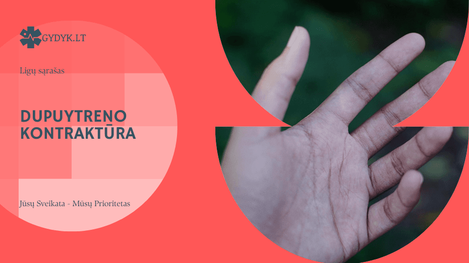 Dupuytreno kontraktūra: priežastys, simptomai ir gydymas