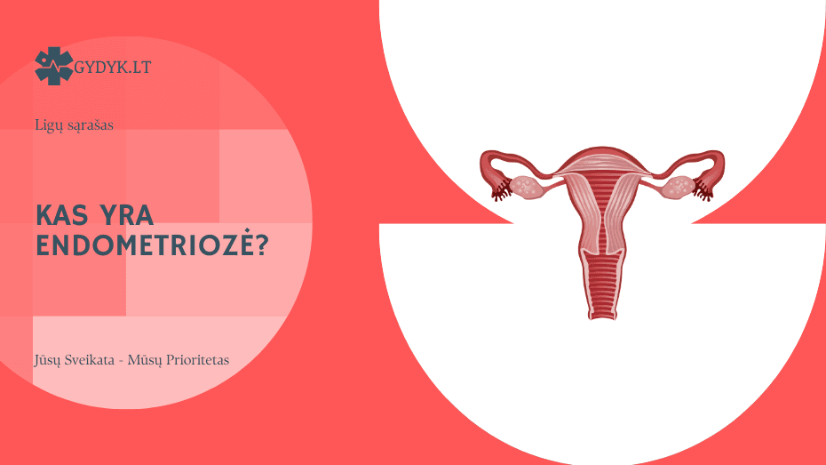 Kas yra endometriozė? Priežastys, simptomai ir gydymas