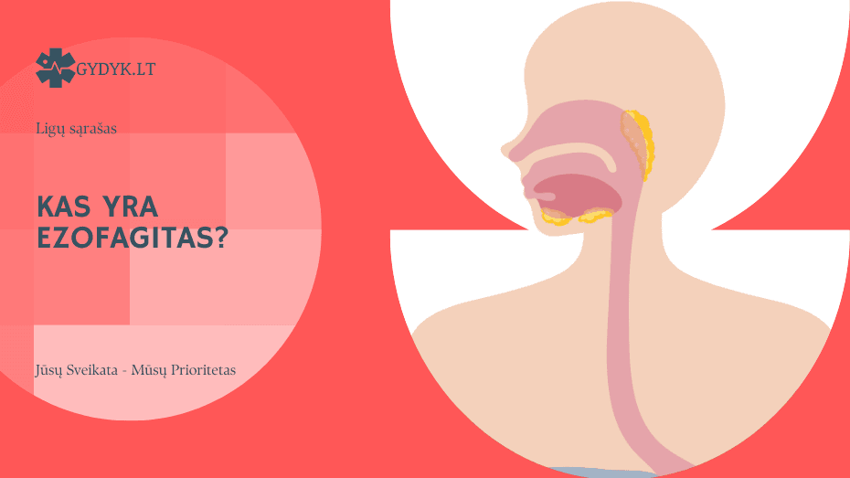 Kas yra ezofagitas? Tipai, priežastys, simptomai ir gydymas